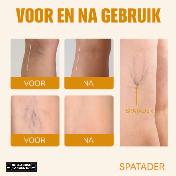 Blauw Licht Verwijderaar voor Spataderen